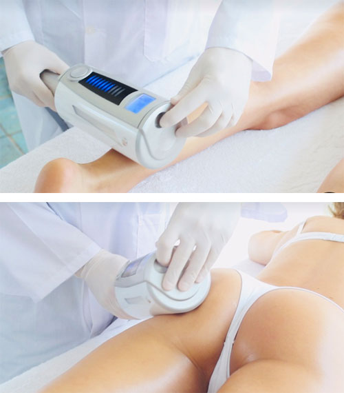 Endospheres Therapy