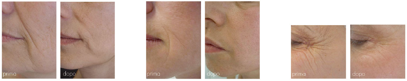 Endospheres Therapy Gesicht Endospheres Therapy Gesicht
