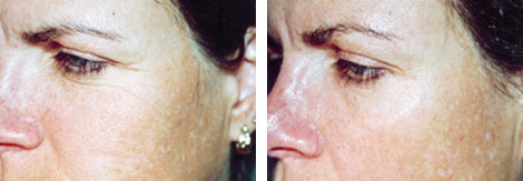 Sauerstofftherapie OxyJet